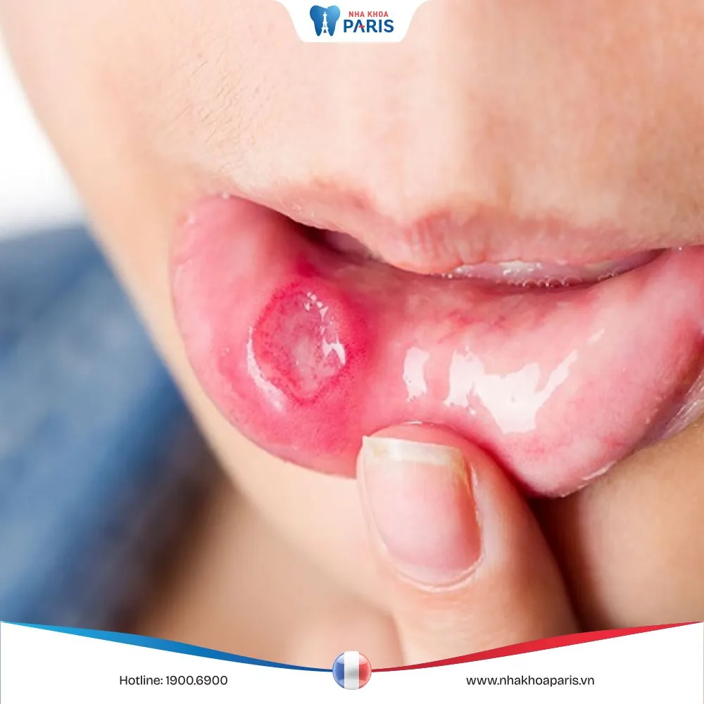 Nổi đẹn là gì? Nguyên nhân và giải pháp điều trị hiệu quả