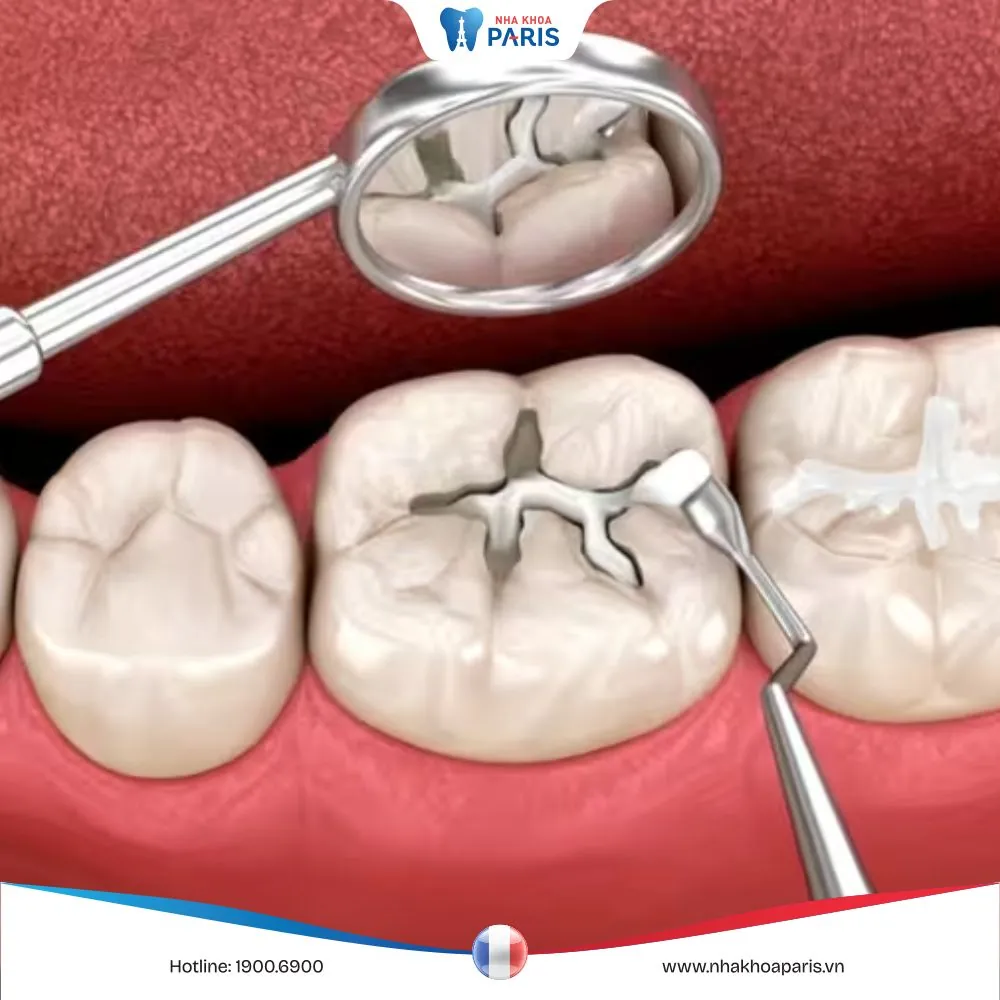Giải đáp: Trám răng nhiều lần thì có làm tổn hại gì không