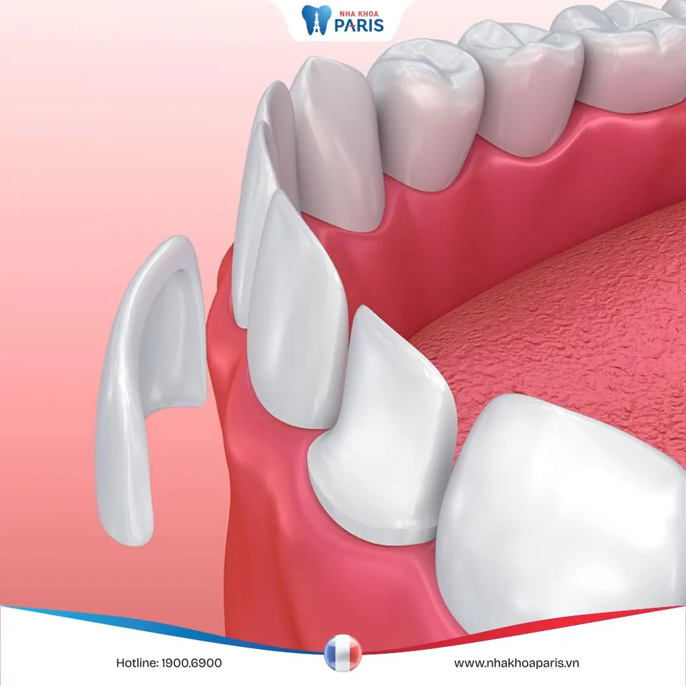 Dán sứ Veneer 2 răng cửa – Hiệu quả nhanh, an toàn, đạt thẩm mỹ