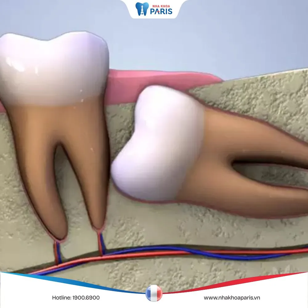 Nhổ răng 48 có nguy hiểm không? Những điều cần lưu ý