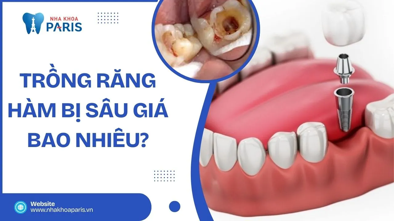 Trồng răng hàm bị sâu giá bao nhiêu? bảng giá mới nhất