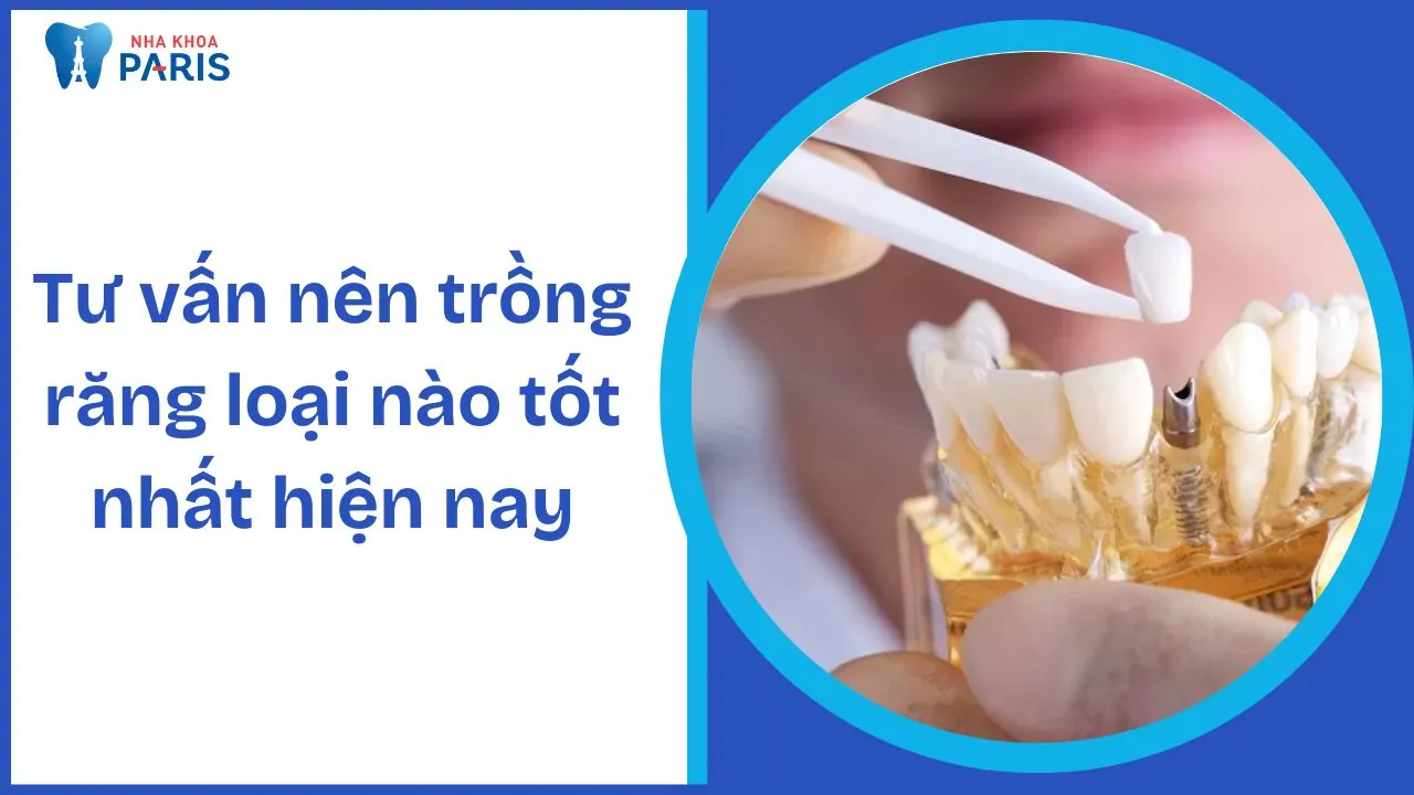 Tư vấn nên trồng răng loại nào tốt nhất hiện nay? So sánh chi tiết từng phương pháp