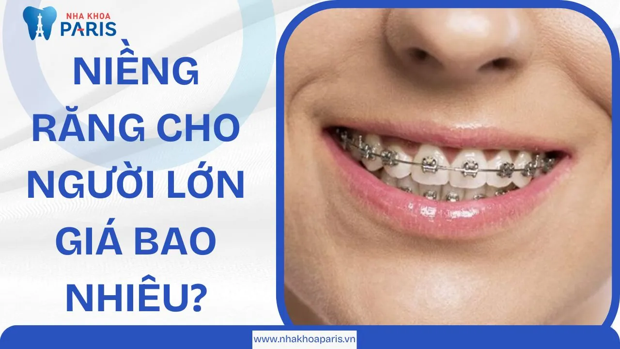 Niềng răng cho người lớn giá bao nhiêu? Quy trình thực hiện