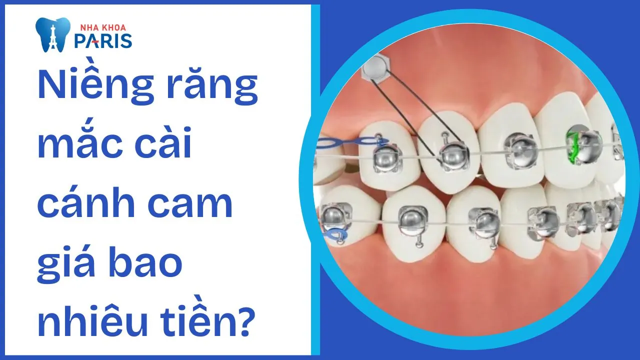 Niềng răng mắc cài cánh cam giá bao nhiêu tiền? 5 yếu tố ảnh hưởng