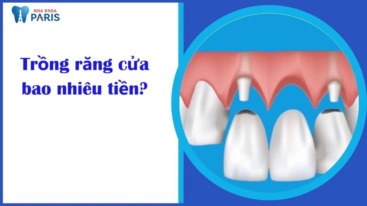 Trồng răng cửa bao nhiêu tiền? yếu tố ảnh hưởng chi phí trồng răng