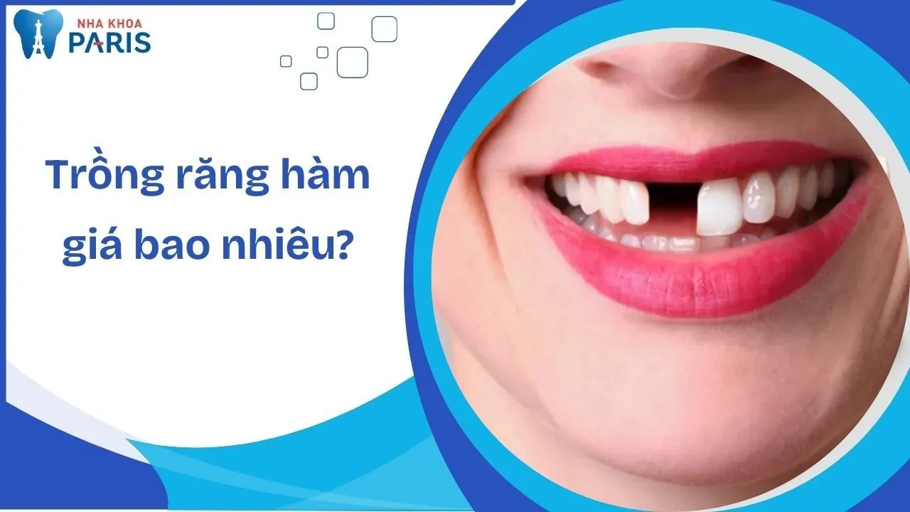 Trồng răng cửa hàm trên giá bao nhiêu? Bảng giá chi tiết