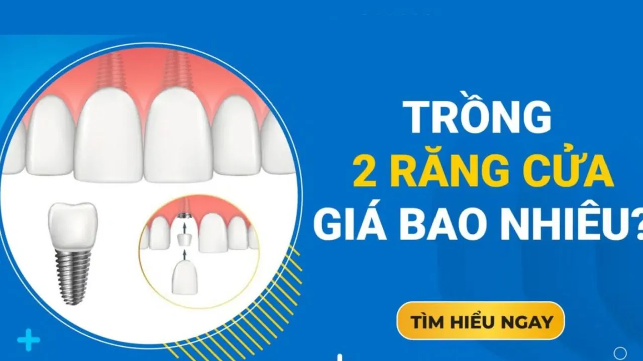 Trồng 2 răng cửa giá bao nhiêu? bảng giá mới nhất