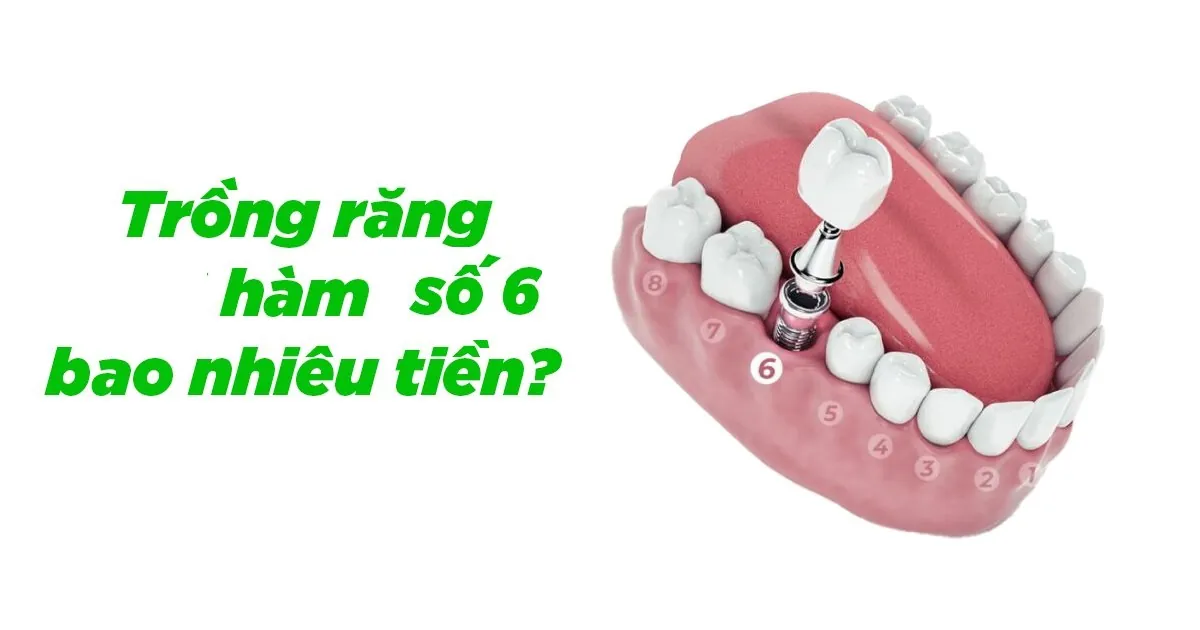 Trồng răng hàm số 6 giá bao nhiêu? Bảng giá mới