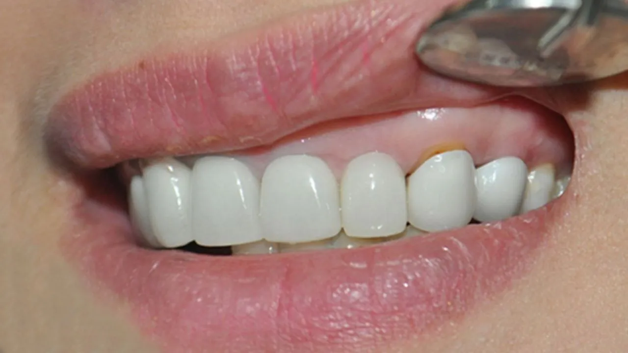 Trồng răng sứ bị cộm? một số nguyên nhân bạn cần biết