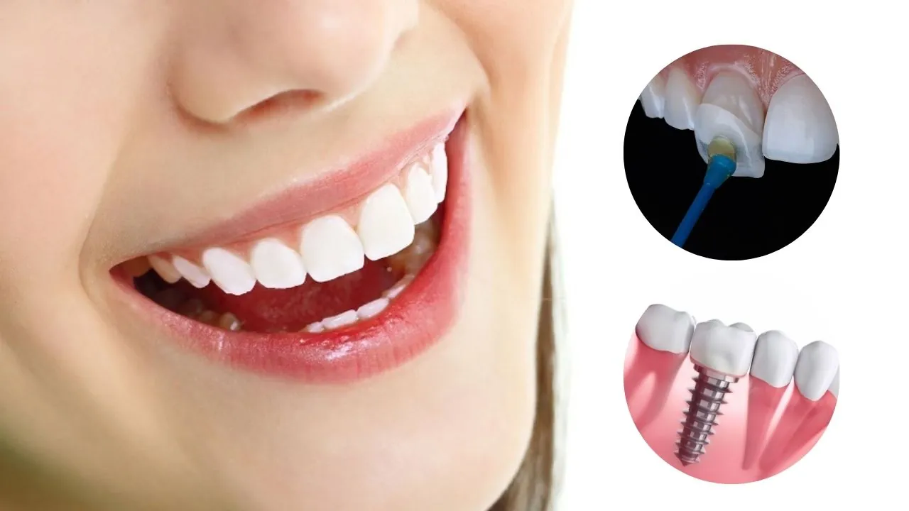 Trồng răng sứ không mài là gì? những trường hợp nào nên làm