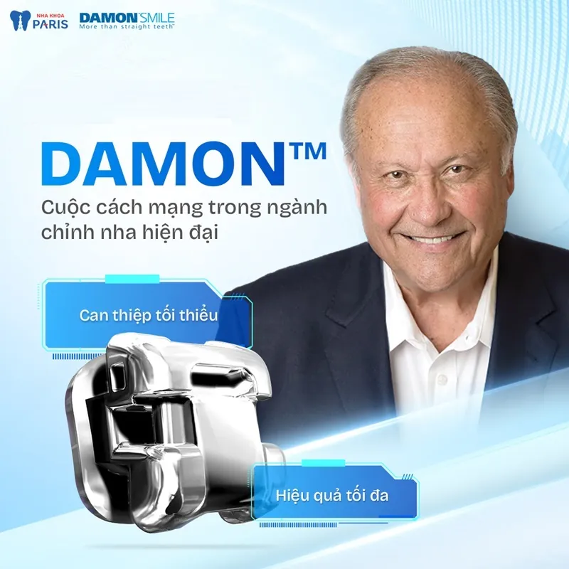 Top 4 lý do bạn nên chỉnh nha bằng mắc cài tự buộc Damon