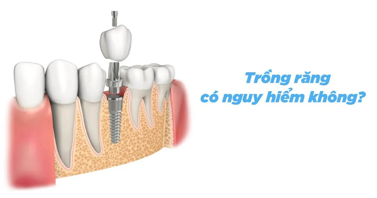 Trồng răng có nguy hiểm không? một số rủi ro bạn nên biết