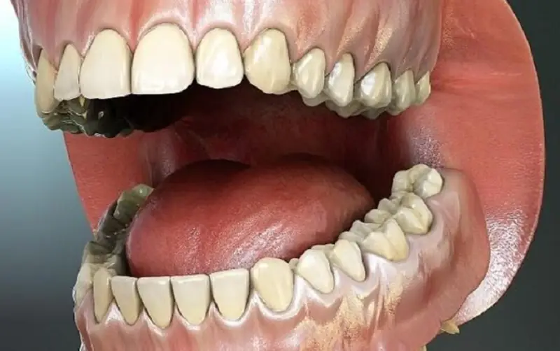 Một hàm răng có bao nhiêu cái? số lượng răng hàm trên/ hàm dưới