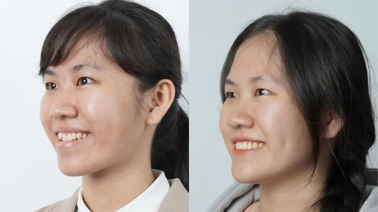 Hồ Huỳnh Thanh Uyên và hành trình niềng răng tại Nha khoa Paris