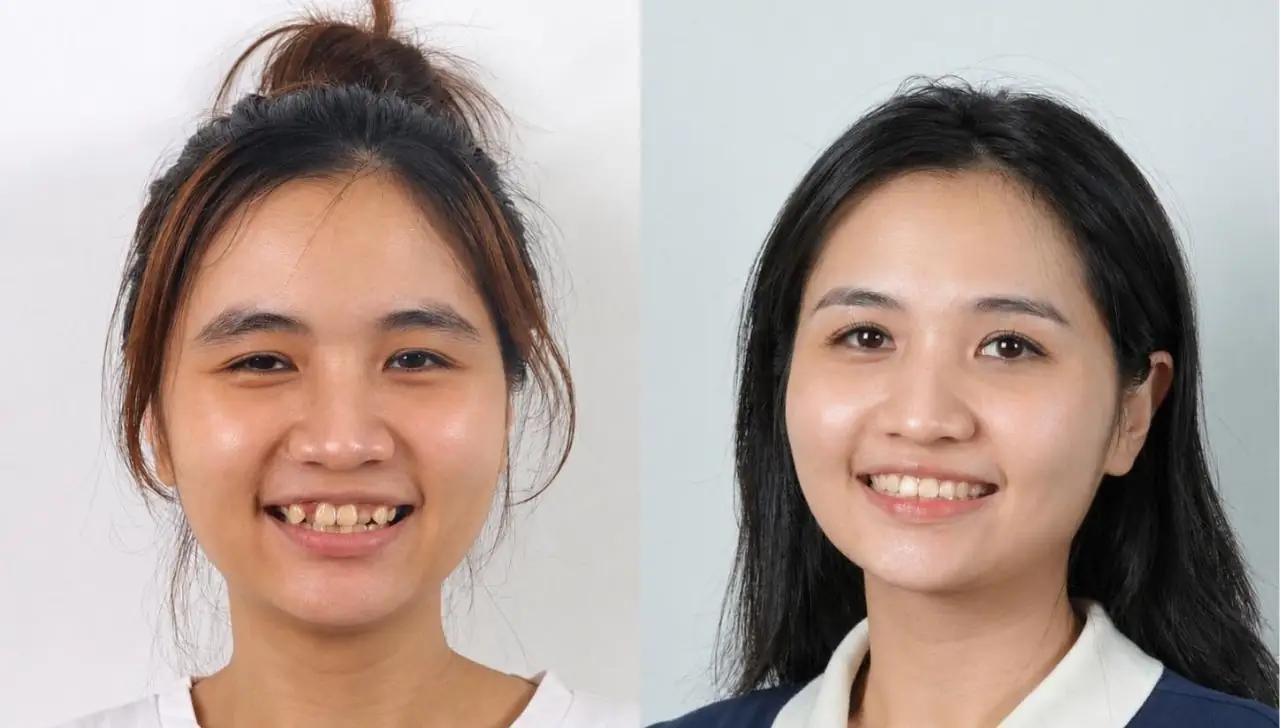 Hành trình niềng răng của Mỹ Phương: Nhổ răng khôn, đặt minivis