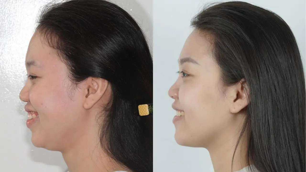 Lâm Nguyễn Kỳ Duyên cải thiện hô hai hàm sau hành trình niềng răng