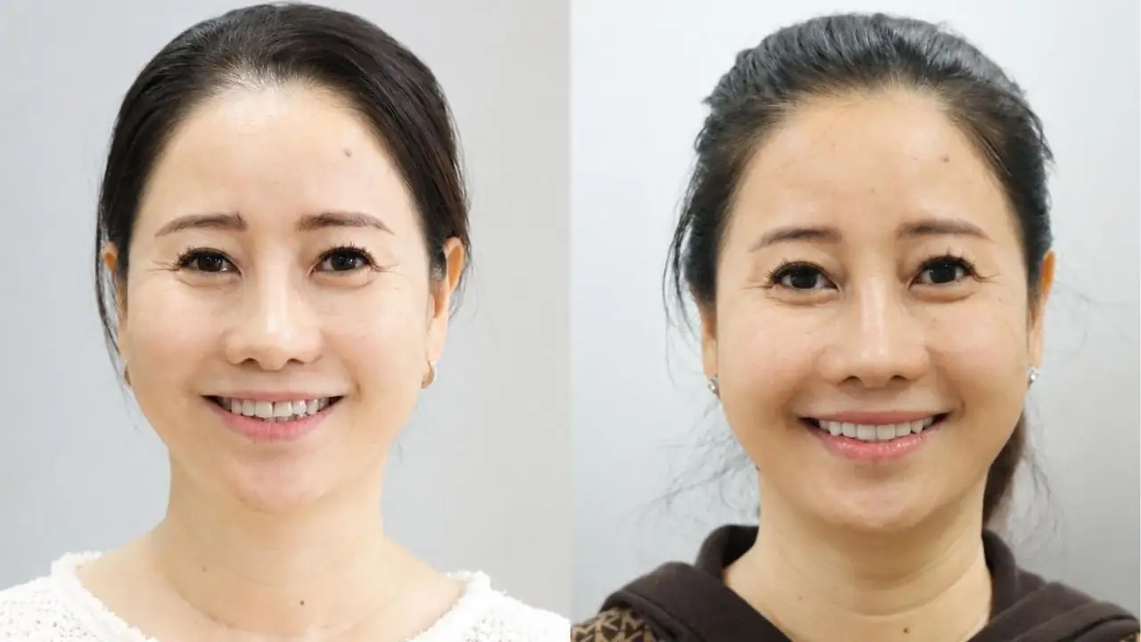 Chị Thái Kim Phúc “tạm biệt” răng xỉn màu sau khi dán 18 Veneer