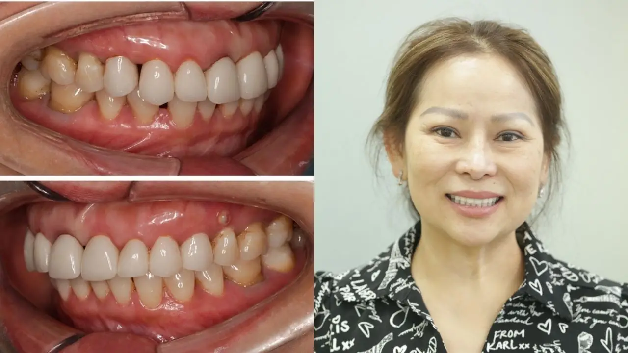 Tô Thị Tuyết Hằng bọc lại răng sứ, khắc phục hàm răng xỉn màu